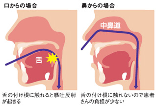 内視鏡挿入画像